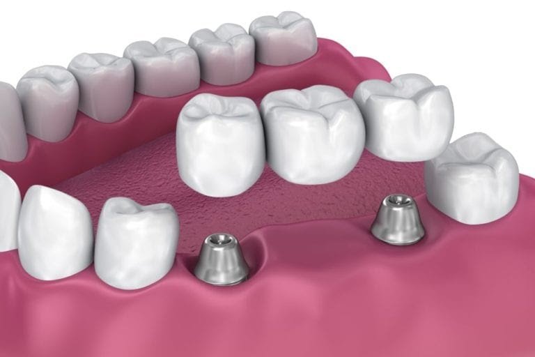 Dental Bridge