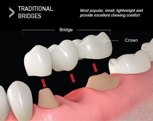Traditional Dental Bridges