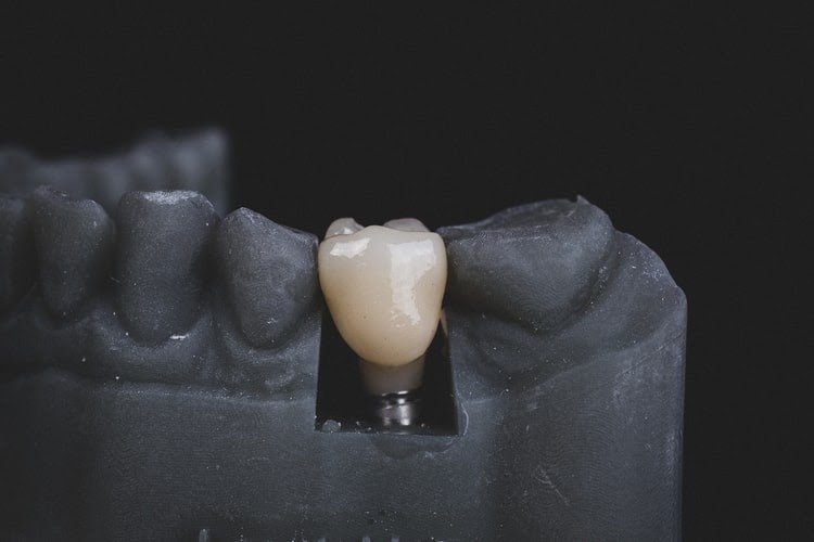 dental-Implants